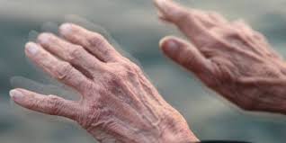 parkinson